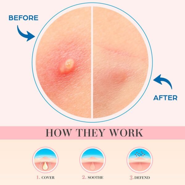 Acne Spot Patches – Hydrocolloid Pimple Stickers for Face, Emergency Blemish & Zit Cover (72 Count) - Image 5
